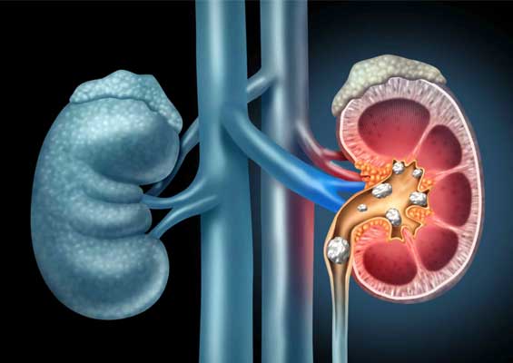 Chronic Kidney Disease